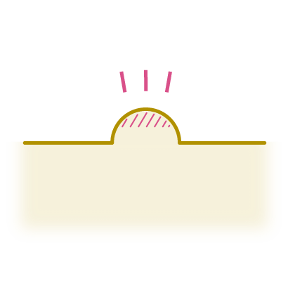 性病の「できもの」